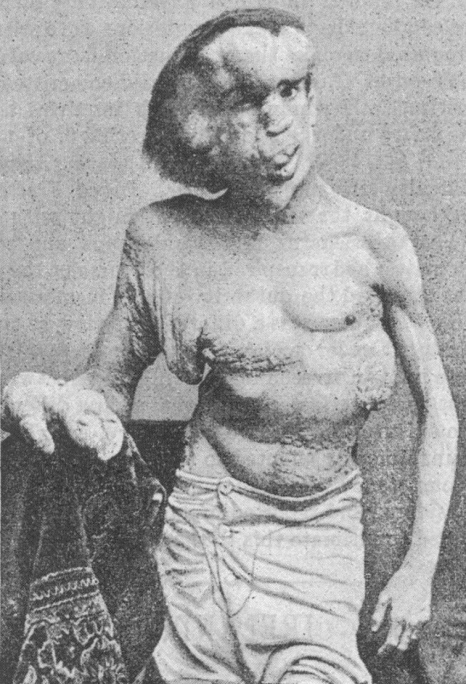 Merrick photographed in 1889, the year before his death - British Medical Journal publication 1890 - Public domain